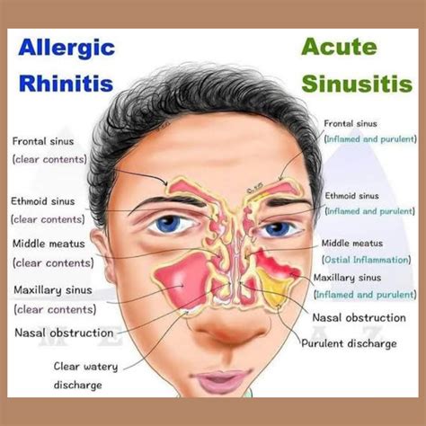 rhinosinusitis wikipedia|rhinosinusitis vs sinusitis.